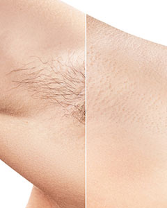 laser hair removal