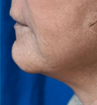after vein treatment