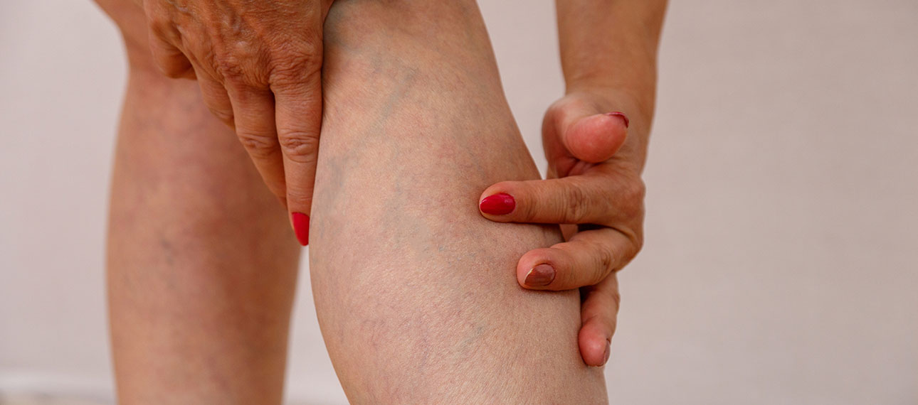 after vein treatment