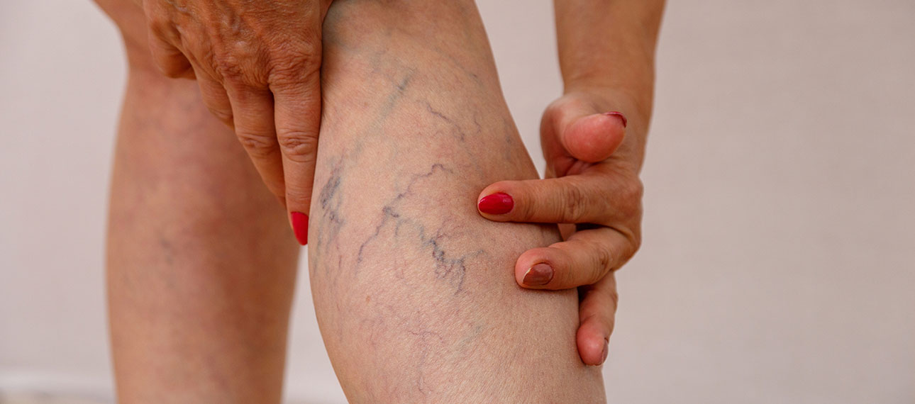 before vein treatment