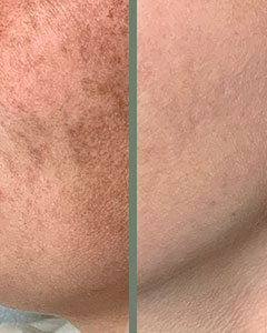 IPL treatment