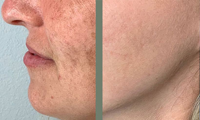 IPL Intense Pulsed Light