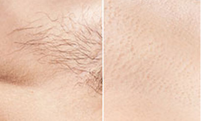 laser hair removal