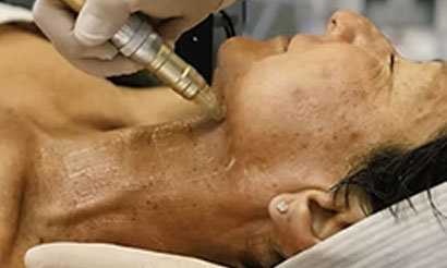 microneedling