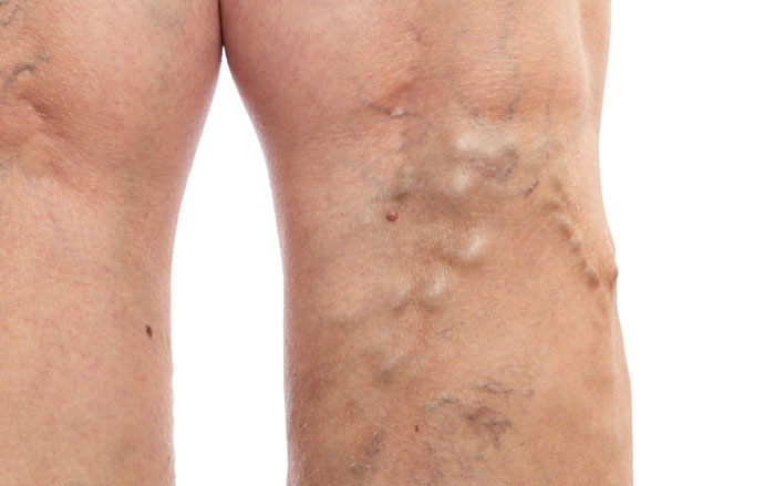 after vein treatment